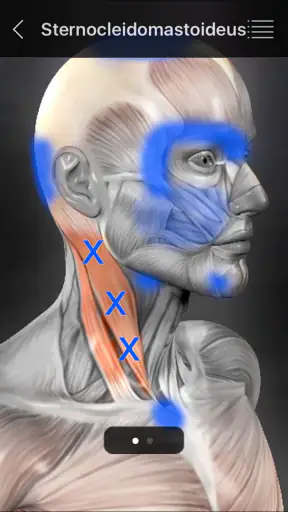 Muskel Triggerpunkte Anatomie screenshot